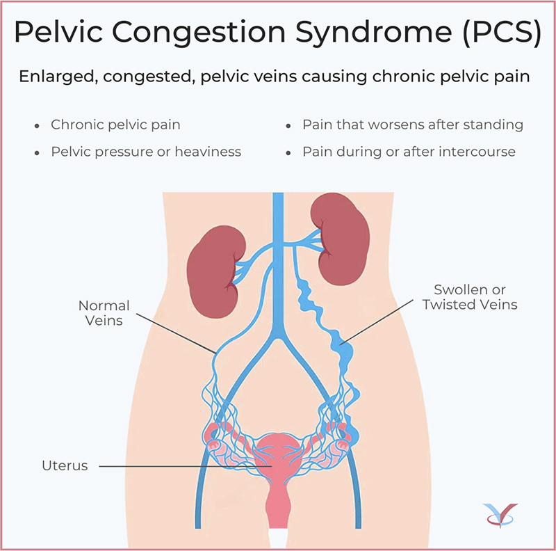 Pelvic Congestion Syndrome Graphic