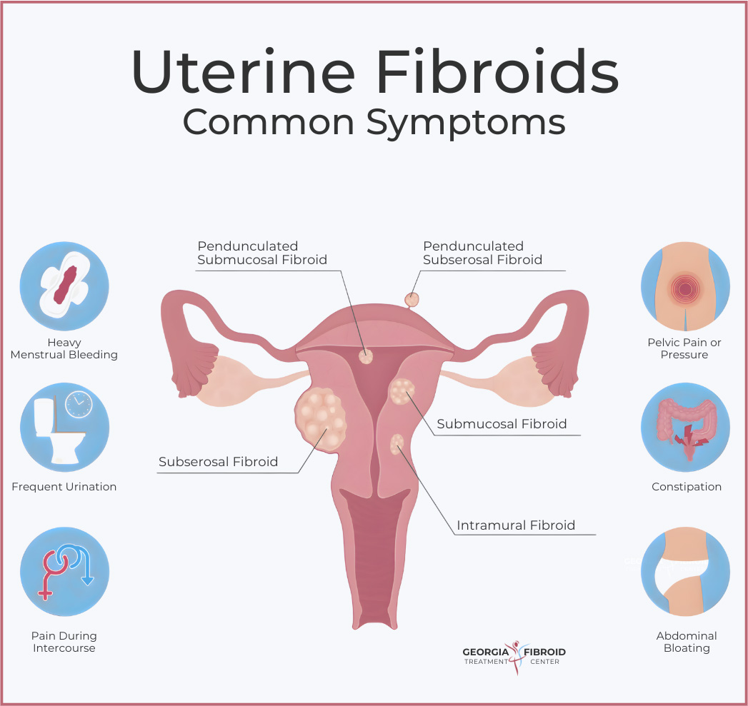 UFE Fibroid Common -Symptoms Graphic