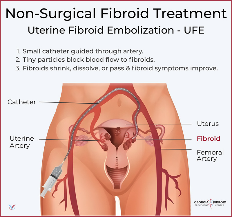 UFE Fibroid Treatment